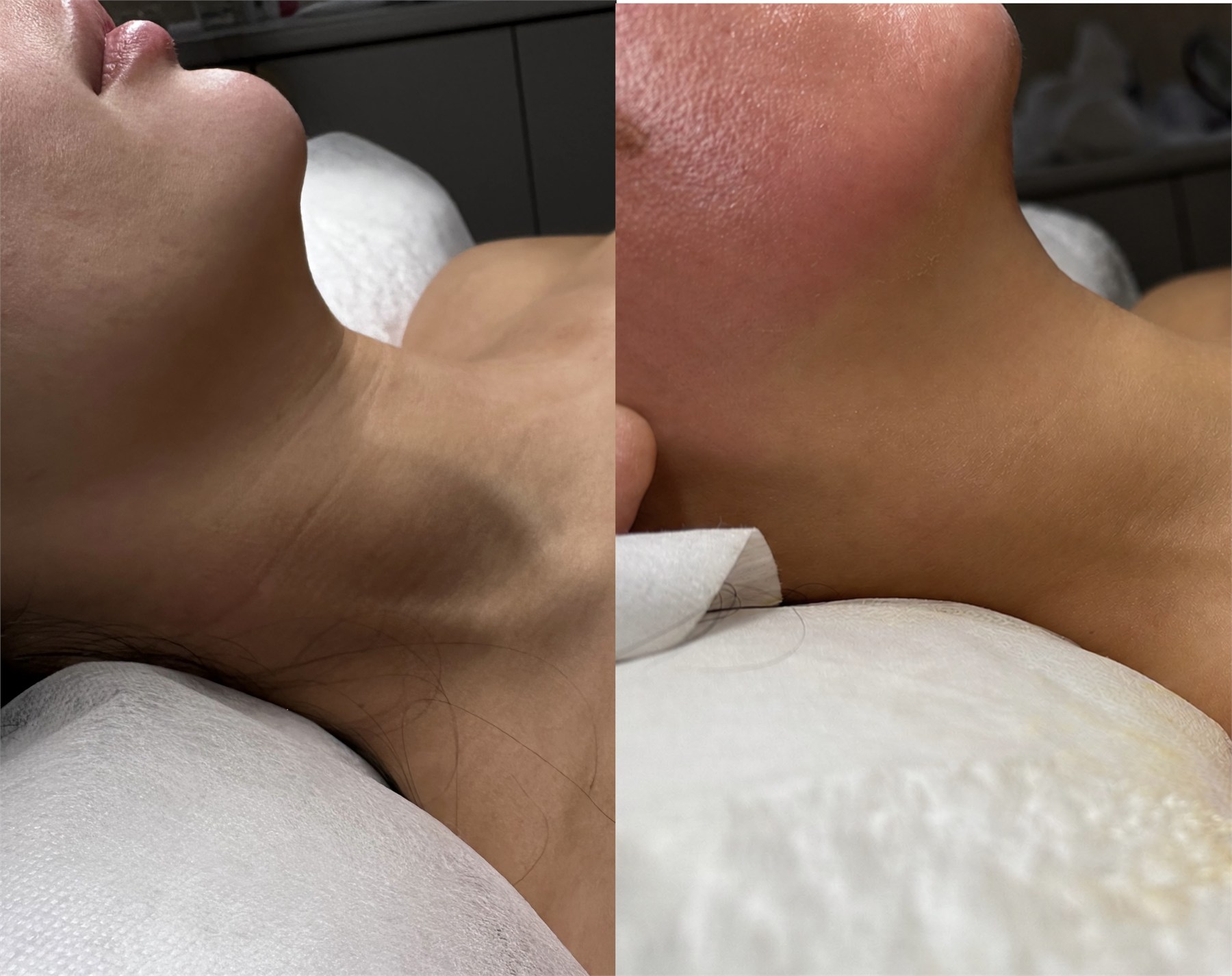 Before and after treatment result showing the neck profile