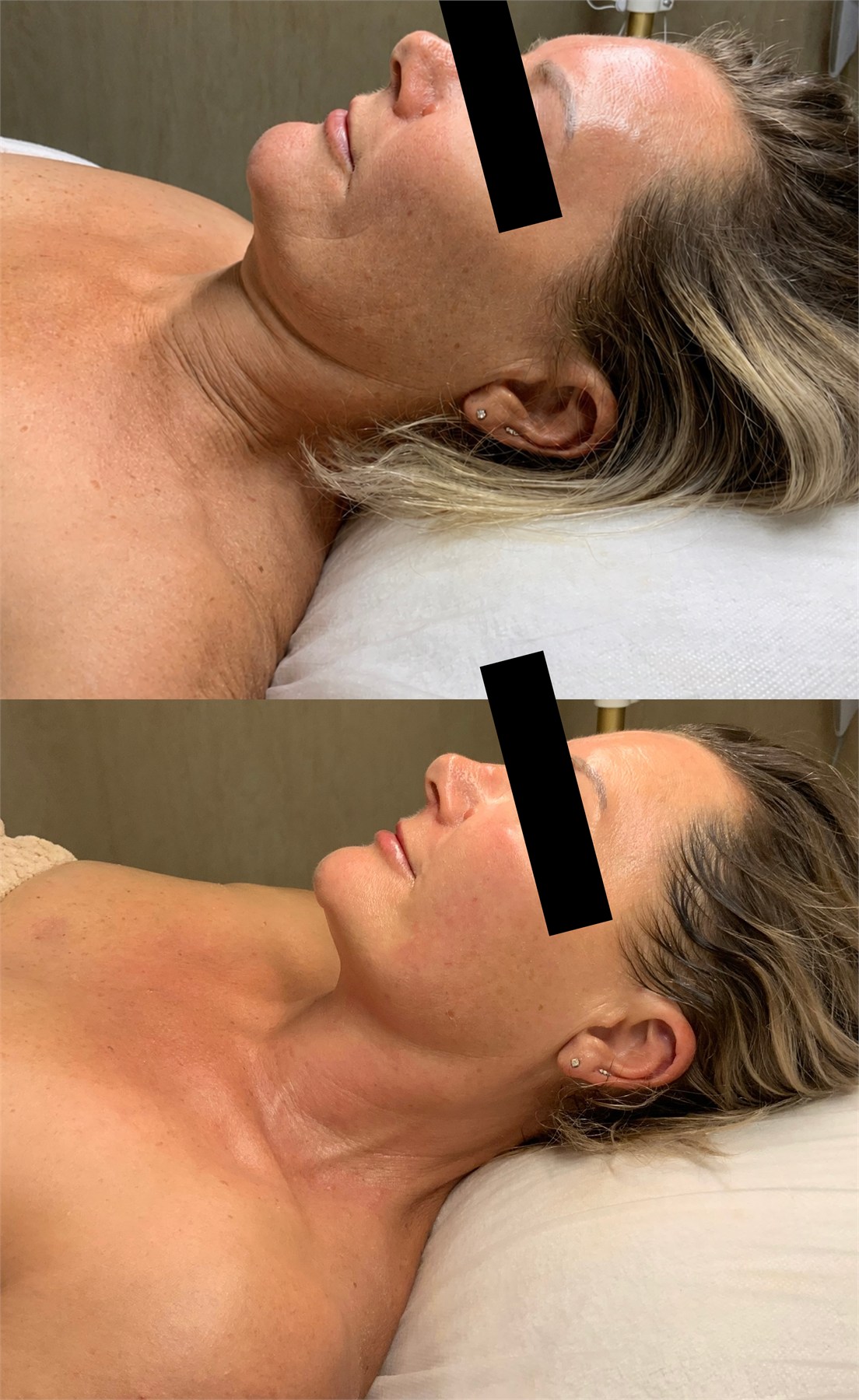 Before and after skin treatment profile comparison