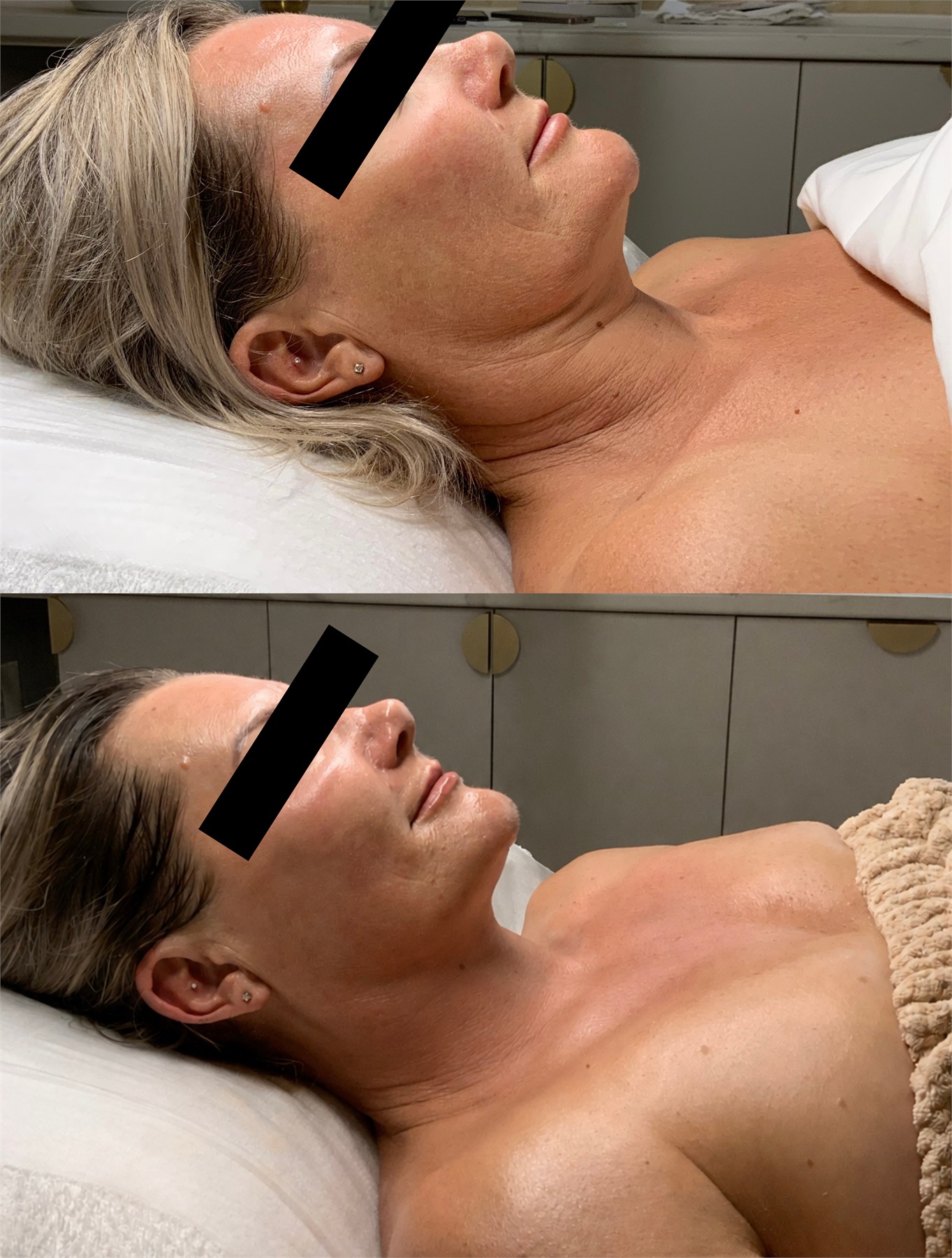 Before and after facial treatment profile comparison