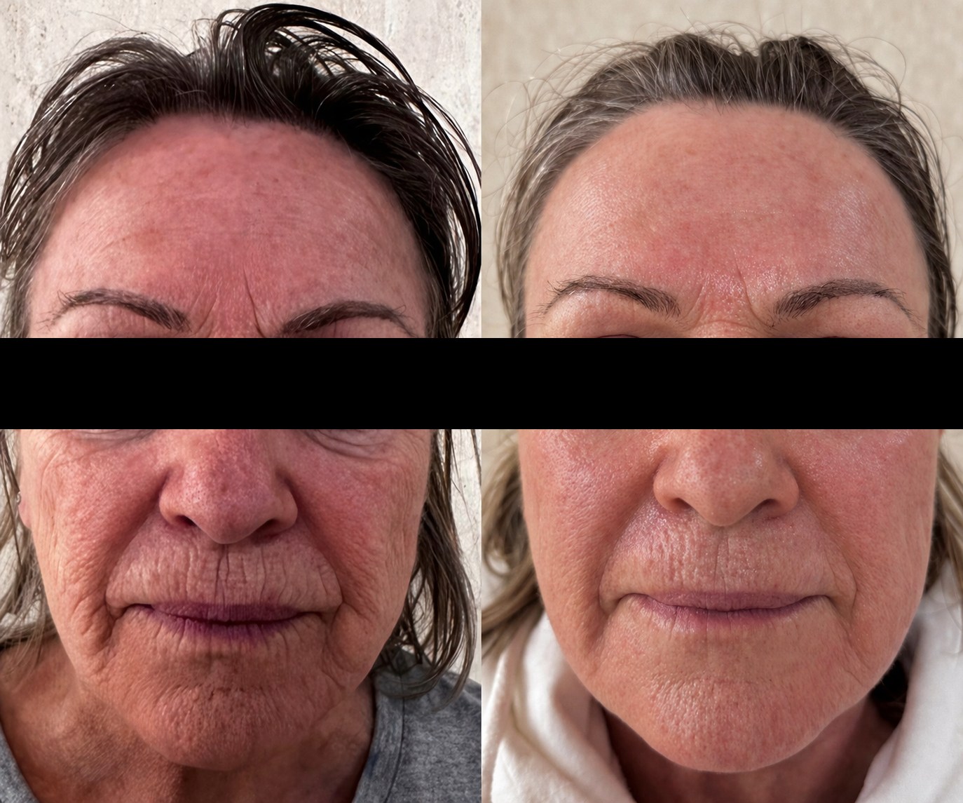 Before and after skin rejuvenation result from the front