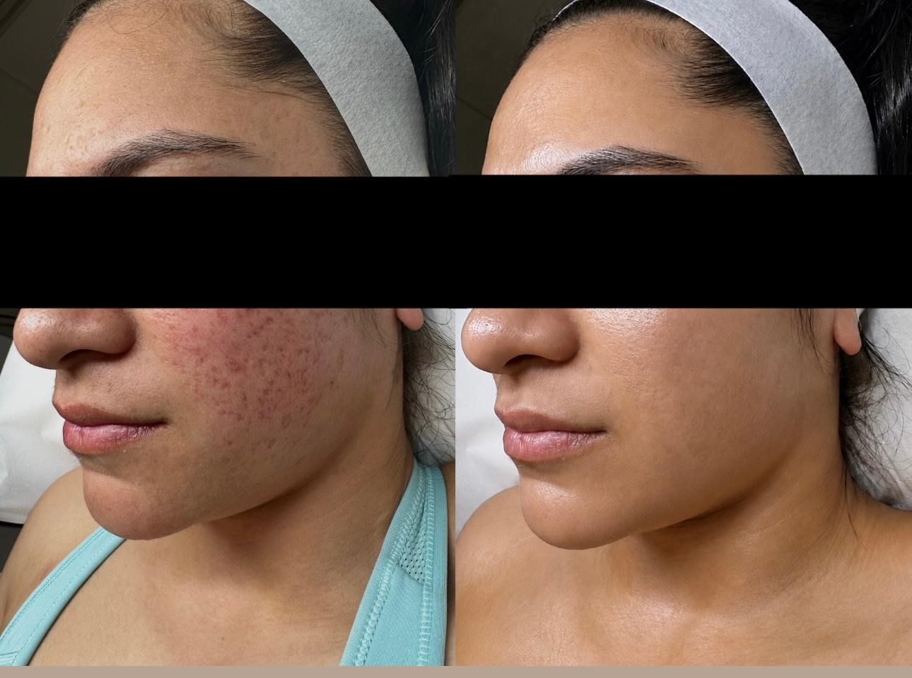 Before and after acne and skin texture treatment result