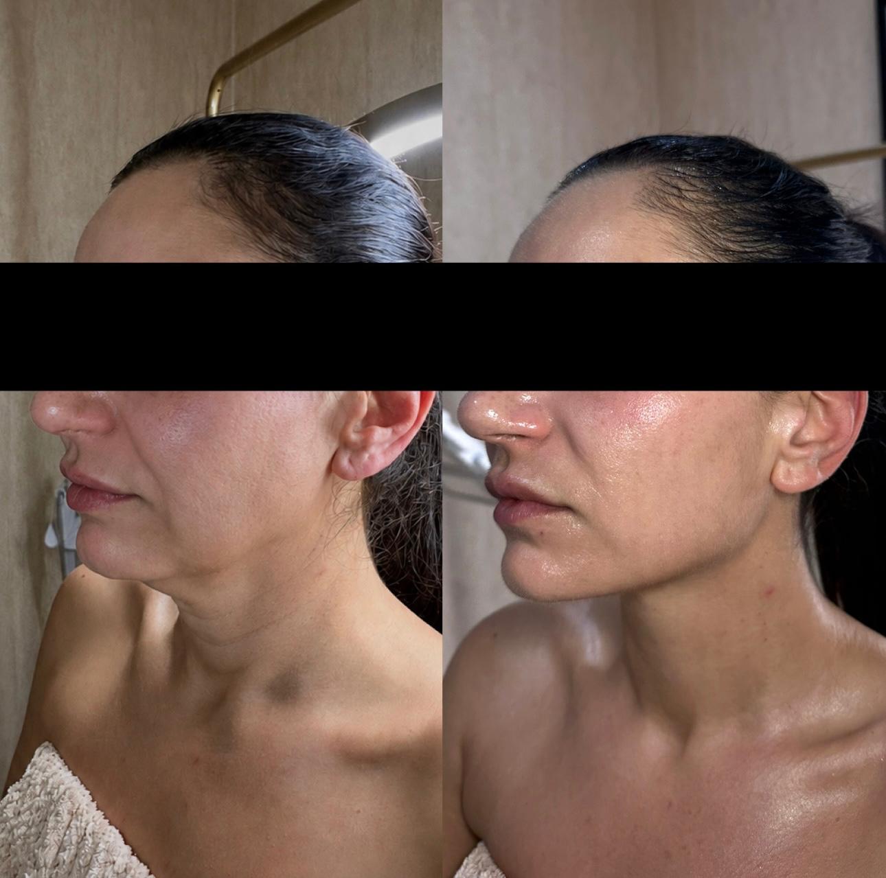 Before and after facial contour and skin treatment result