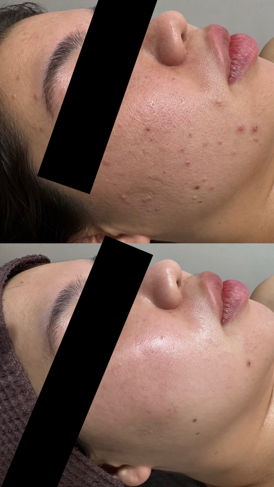Before and after acne and skin clarity treatment result