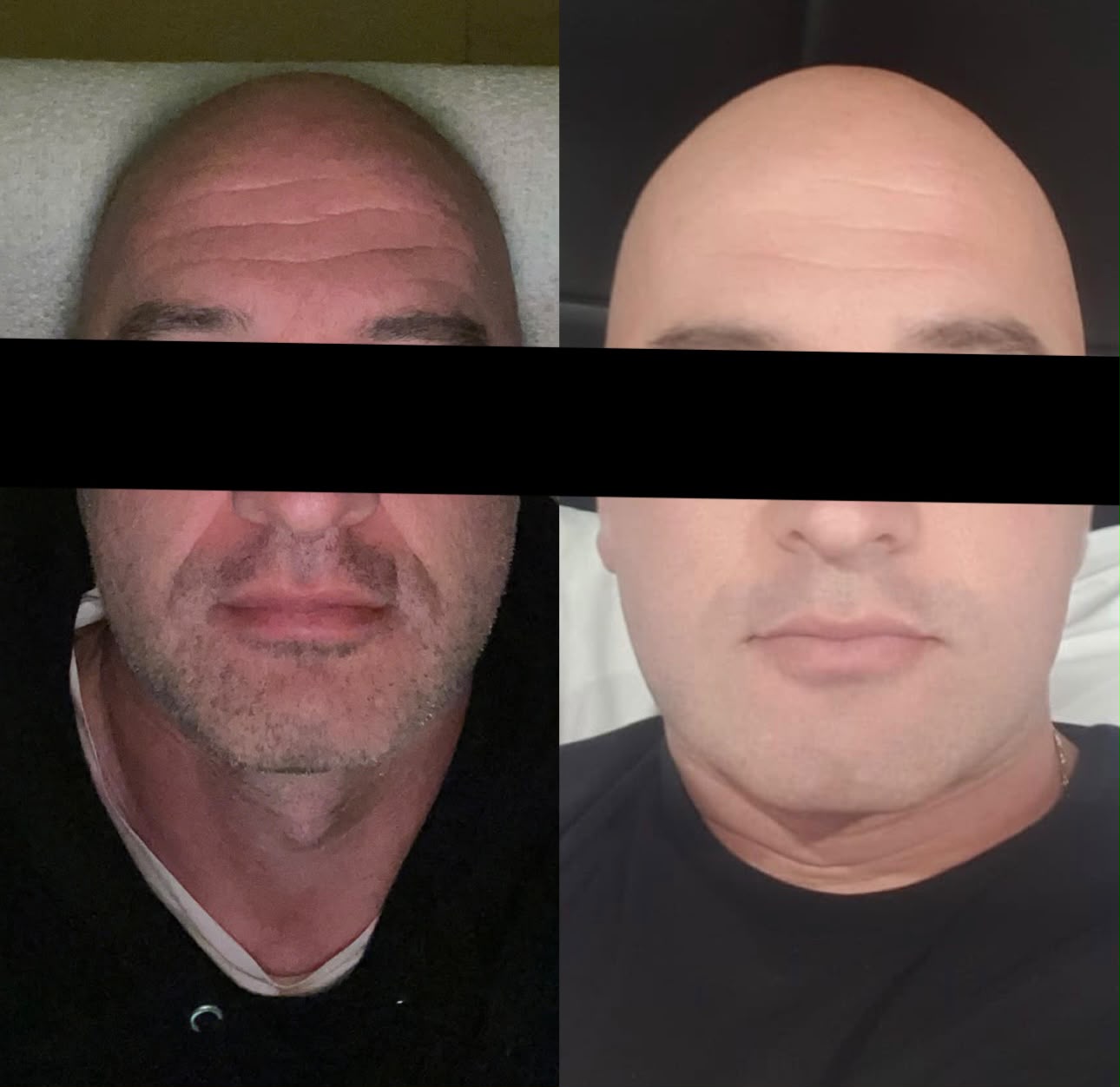 Before and after personalised treatment result for a male client