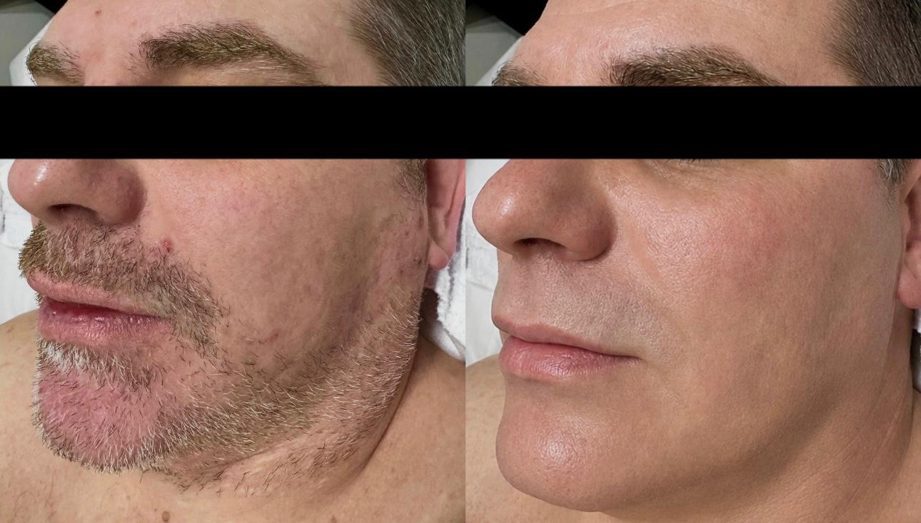 Before and after male facial skin renewal treatment result