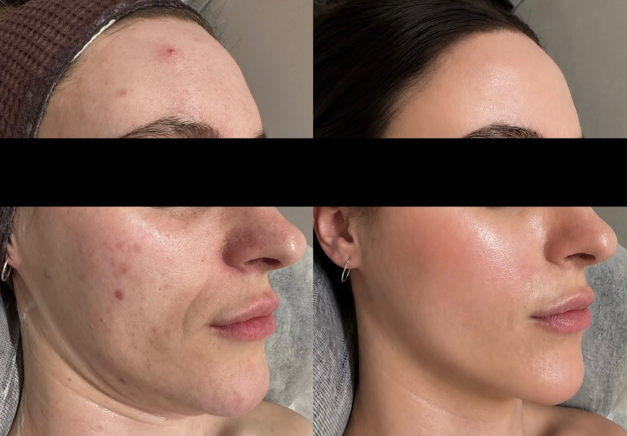 Before and after facial skin treatment profile result