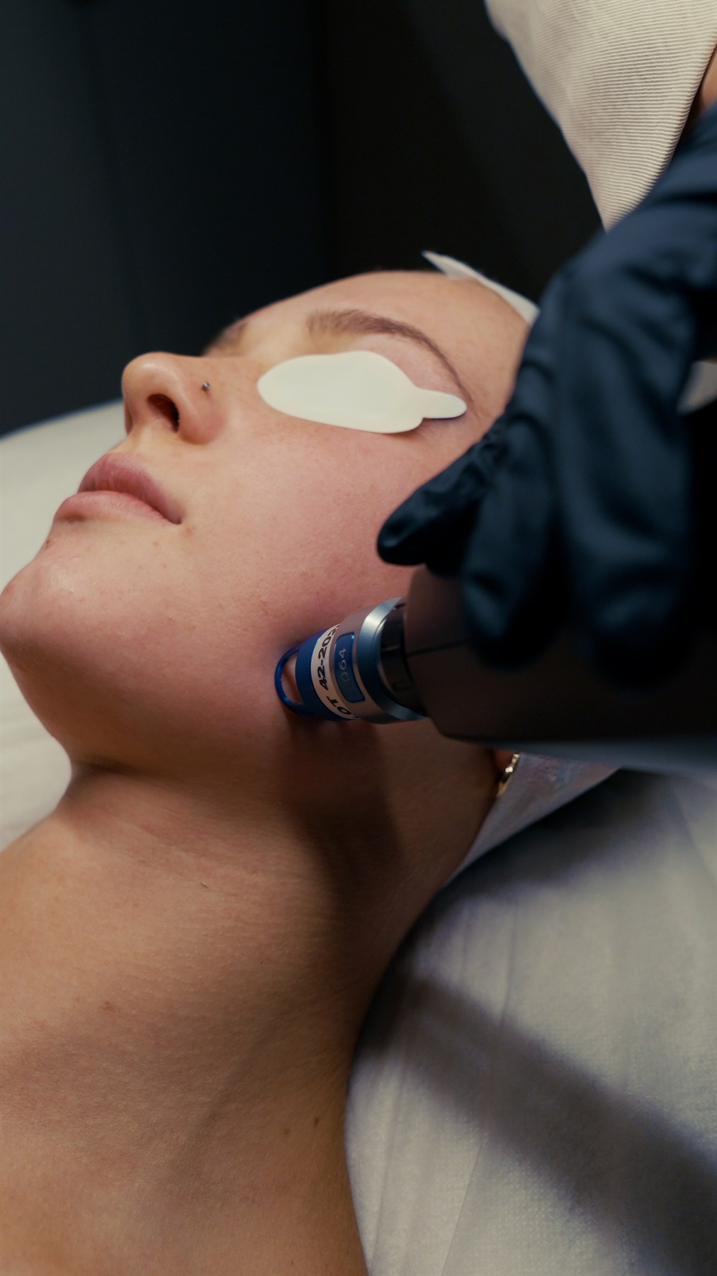 Redness & Vascular Laser